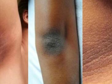 4 Superbes astuces pour éclaircir vos coudes, jambes et genoux noirs facilement…