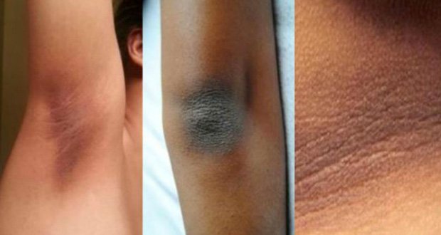 4 Superbes astuces pour éclaircir vos coudes, jambes et genoux noirs facilement…